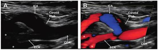 正確的電源穩壓器能最大限度地減少直流電軌噪聲並提高超聲圖像的質量