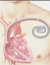 細數心髒起搏器和ICD之間的差異