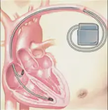 細數心髒起搏器和ICD之間的差異